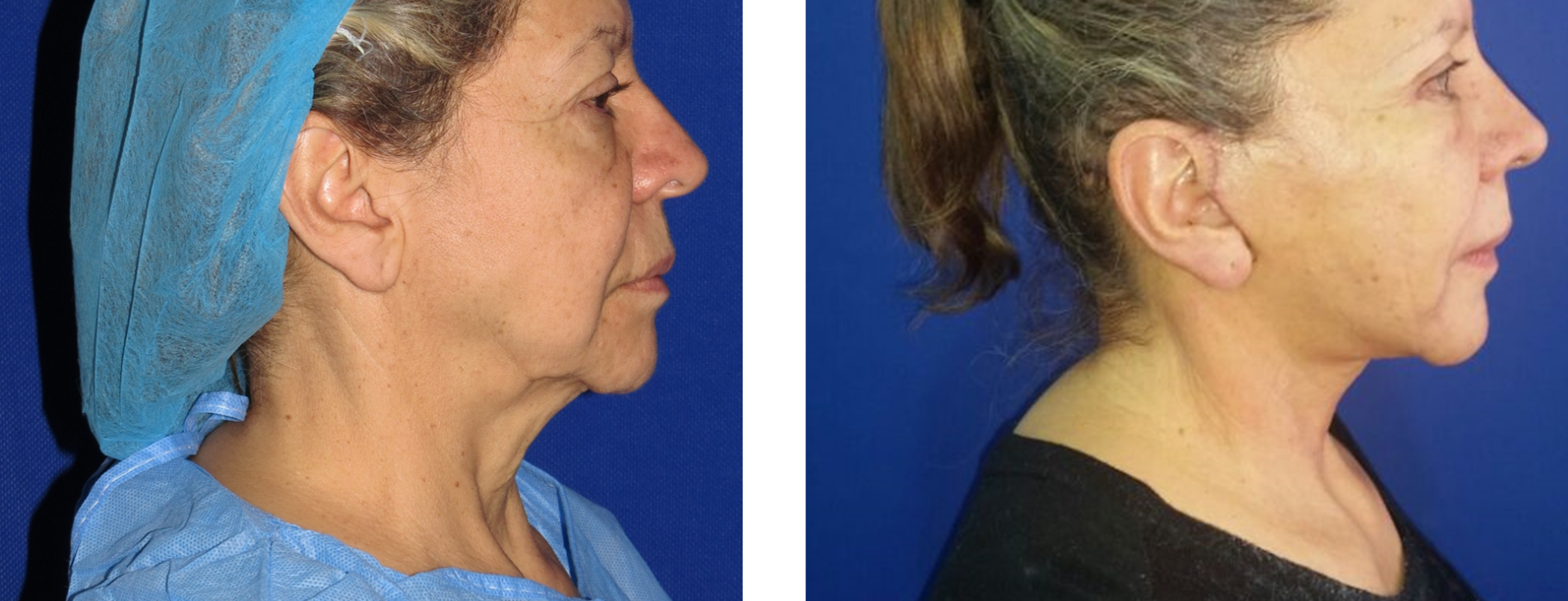 Antes