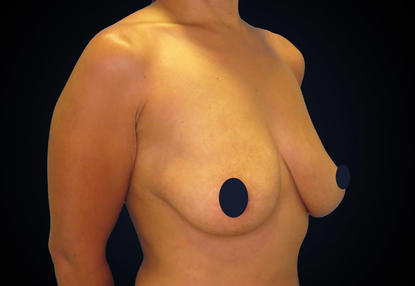 Maxtopexia con Implantes ANTES